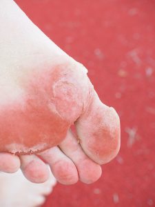 Carney Rot: Toe fungus from the showers. 